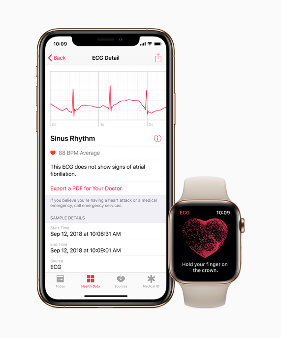 ECG app and irregular heart rhythm 
